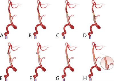 Application of Balloon AngioplaSty with the dIstal protection of Stent Retriever (BASIS) technique for acute intracranial artery atherosclerosis-related occlusion